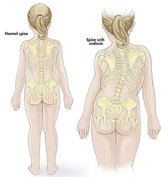 Difference of normal spine vs spine with scoliosis