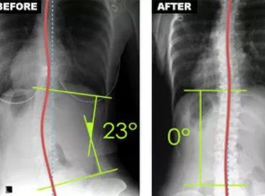 Scoliosis Correction Method