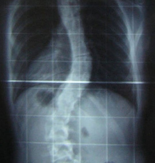 Bracing Surgery
