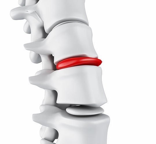 Disc Herniation
